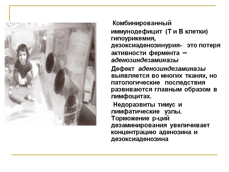 Комбинированный  иммунодефицит (Т и В клетки) гипоурикемия, дезоксиаденозинурия-  это потеря активности фермента